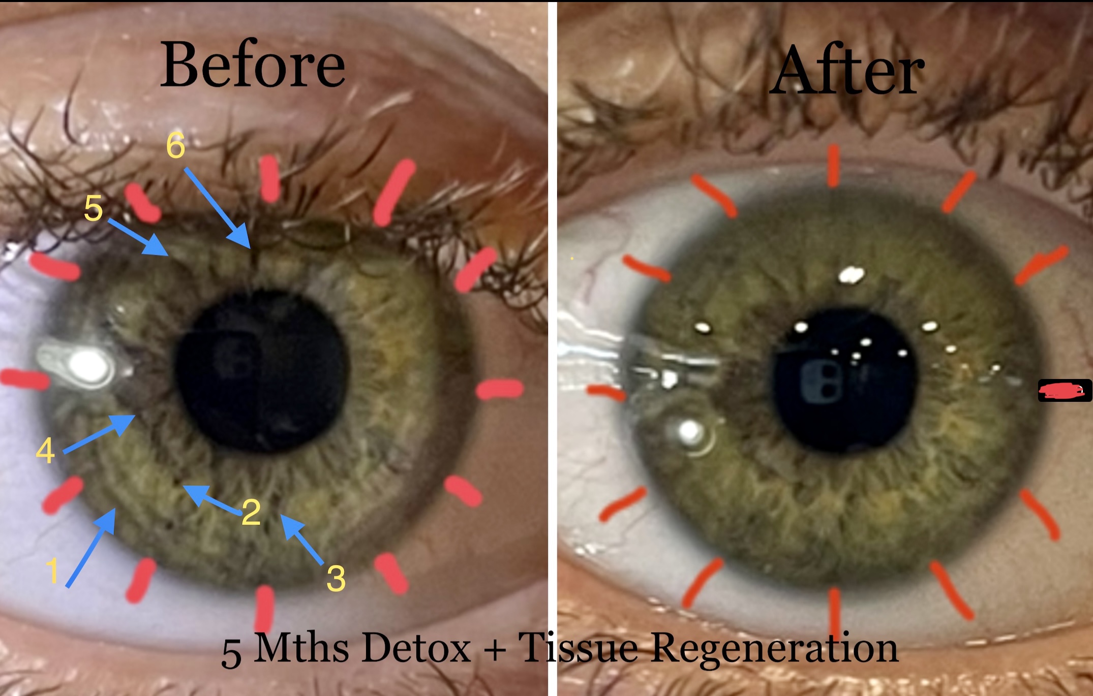 Iris Analysis Alka Clean Detox And Tissue Regeneration